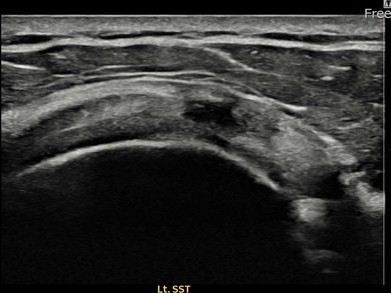 좌측 극상근건 관절면측 부분파열 비수술 치료 전 초음파 — 플래티넘의원