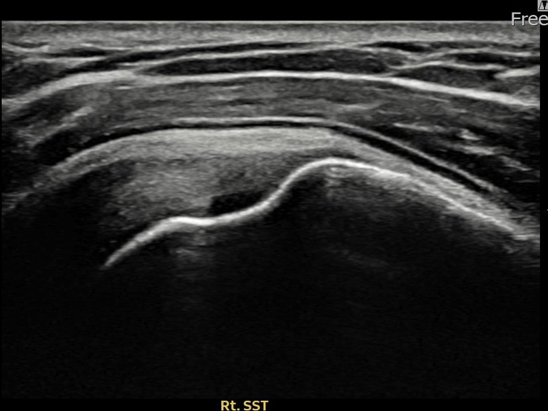 우측 극상근건 부착부 부분파열 비수술 치료 후 초음파 — 플래티넘의원