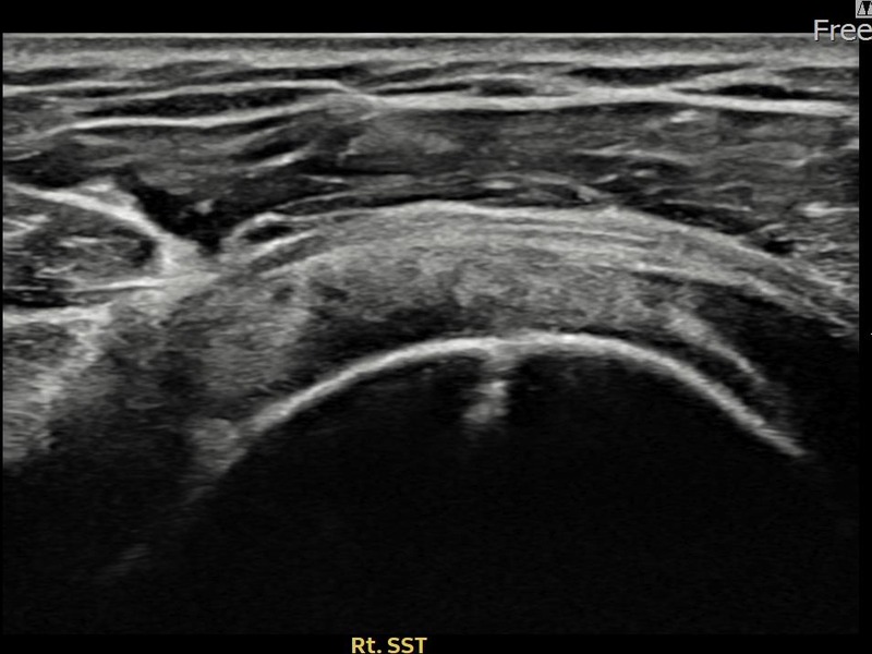 우측 극상근건 관절면측 부분파열 비수술 치료 후 초음파 — 플래티넘의원