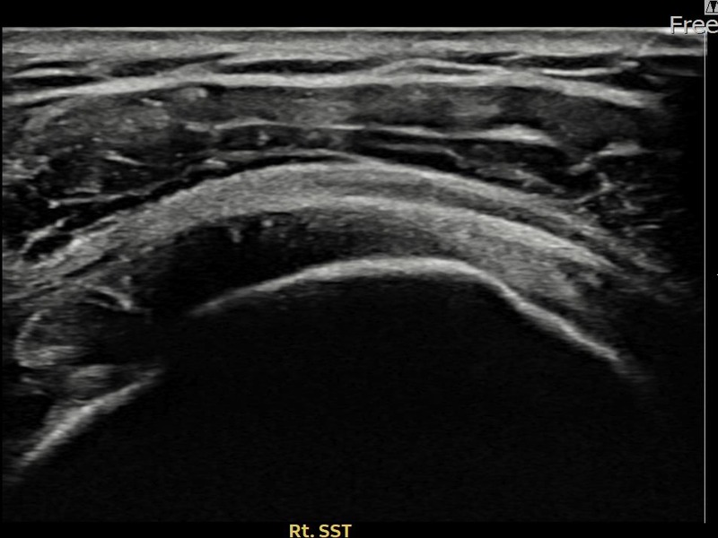 우측 극상근건 관절면측 부분파열 비수술 치료 전 초음파 — 플래티넘의원