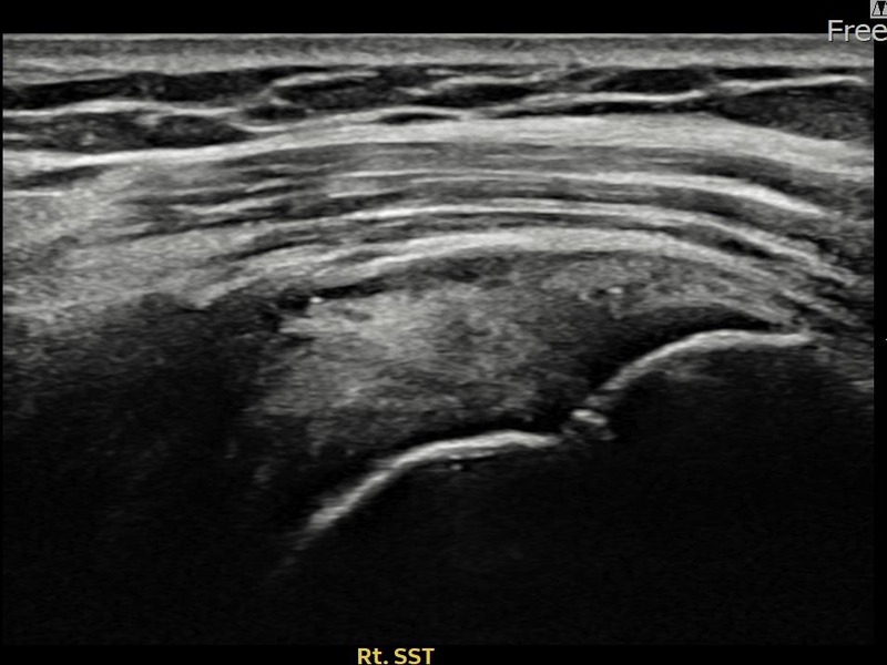 우측 극상근건 점액낭면측 부분파열 비수술 치료 후 초음파 — 플래티넘의원