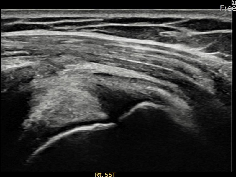 우측 극상근건 점액낭면측 부분파열 비수술 치료 전 초음파 — 플래티넘의원