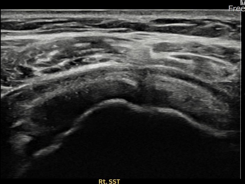 우측 극상근건 관절면측 부분파열 비수술 치료 전 초음파 — 플래티넘의원