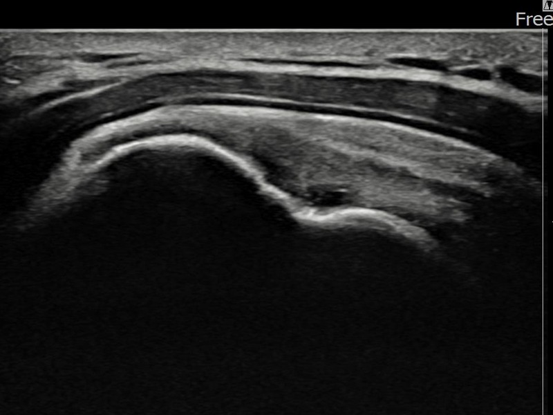 좌측 극상근건 부착부 광범위 부분파열 비수술 치료 후 초음파 — 플래티넘의원