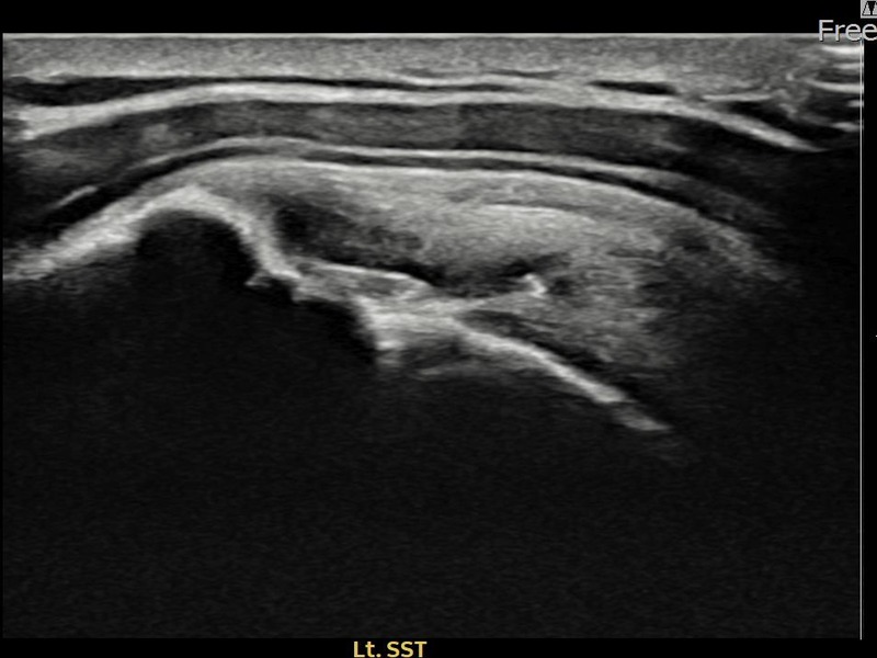 좌측 극상근건 부착부 광범위 부분파열 비수술 치료 전 초음파 — 플래티넘의원