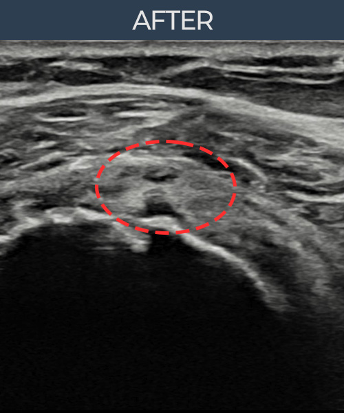 회전근개 부분파열 비수술 치료 후 초음파 — 플래티넘의원