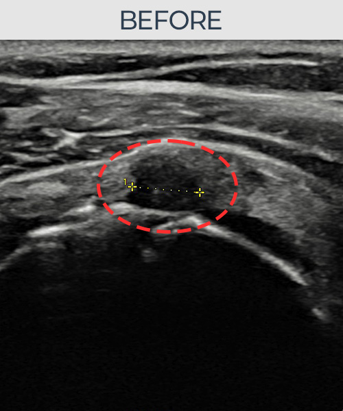 회전근개 부분파열 비수술 치료 전 초음파 — 플래티넘의원