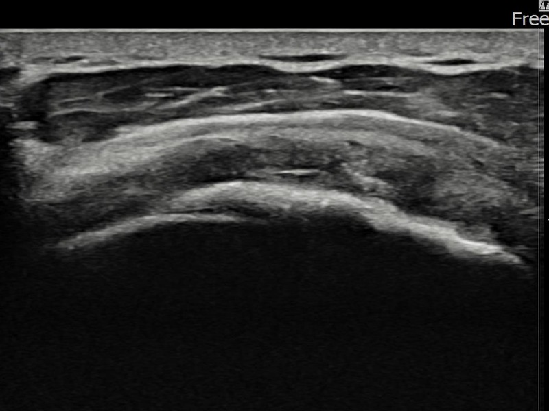 좌측 극상근건 광범위 부분파열 비수술 치료 후 초음파 — 플래티넘의원