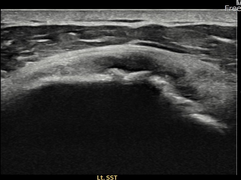 좌측 극상근건 광범위 부분파열 비수술 치료 전 초음파 — 플래티넘의원
