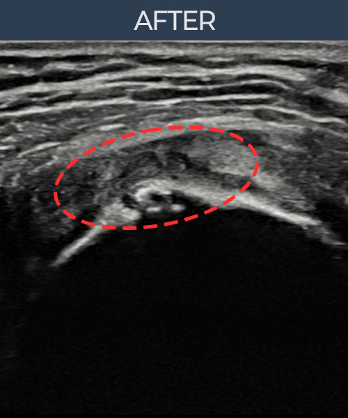 회전근개 관절면측 파열 비수술 치료 후 초음파 — 플래티넘의원