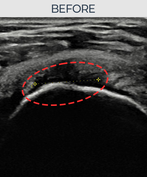 회전근개 관절면측 파열 비수술 치료 전 초음파 — 플래티넘의원
