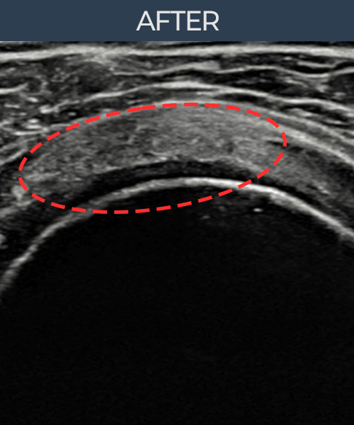 회전근개 부분파열 + 인대 손상 비수술 치료 후 초음파 — 플래티넘의원