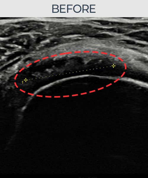 회전근개 부분파열 + 인대 손상 비수술 치료 전 초음파 — 플래티넘의원
