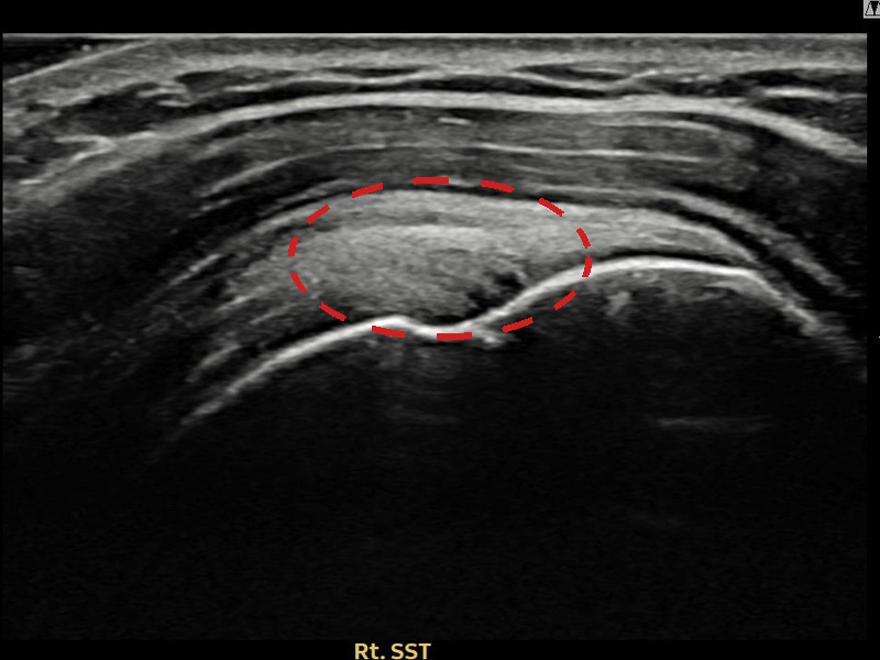 우측 극상근건 관절면측 부분파열 비수술 치료 후 초음파 — 플래티넘의원
