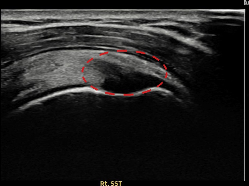우측 극상근건 관절면측 부분파열 비수술 치료 전 초음파 — 플래티넘의원