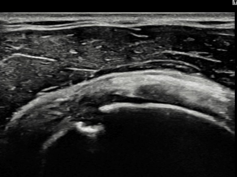 우측 극상근건 점액낭면측 부분파열 비수술 치료 전 초음파 — 플래티넘의원