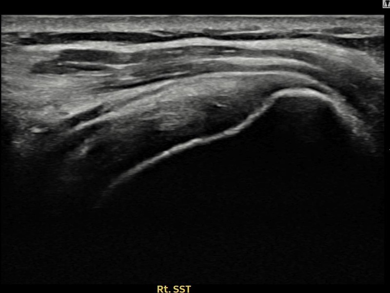 우측 극상근건 관절면측 부분파열 비수술 치료 전 초음파 — 플래티넘의원