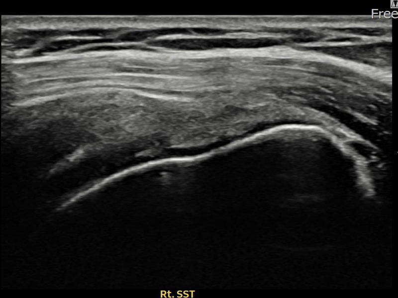 우측 극상근건 관절면측 부분파열 비수술 치료 후 초음파 — 플래티넘의원