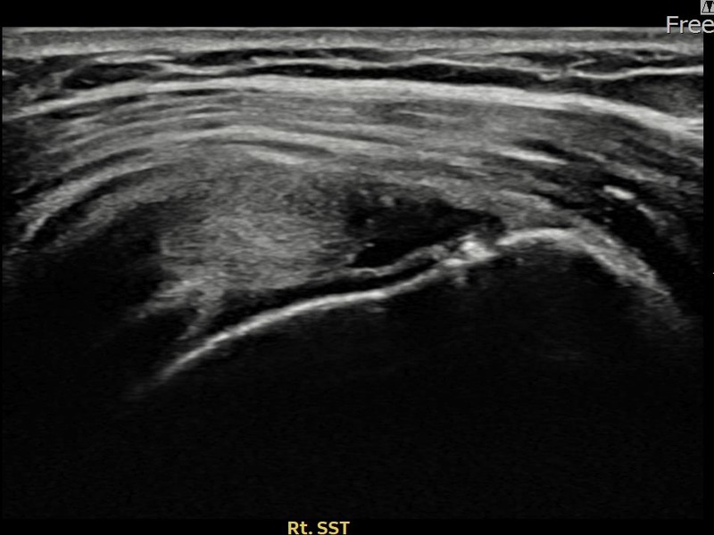 우측 극상근건 관절면측 부분파열 비수술 치료 전 초음파 — 플래티넘의원