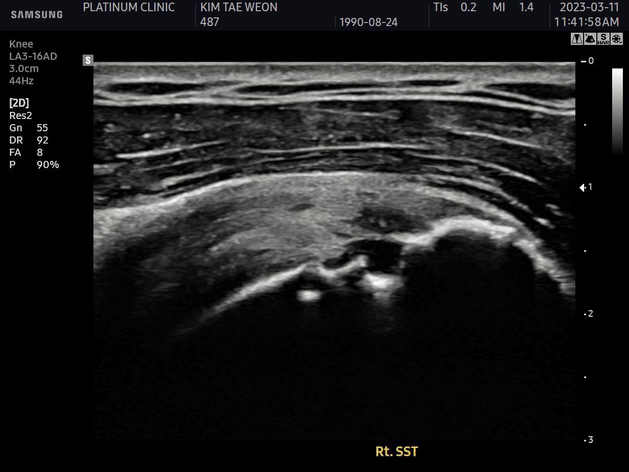 초음파 검사 중 결대로 찢어진 회전근개 파열 영상