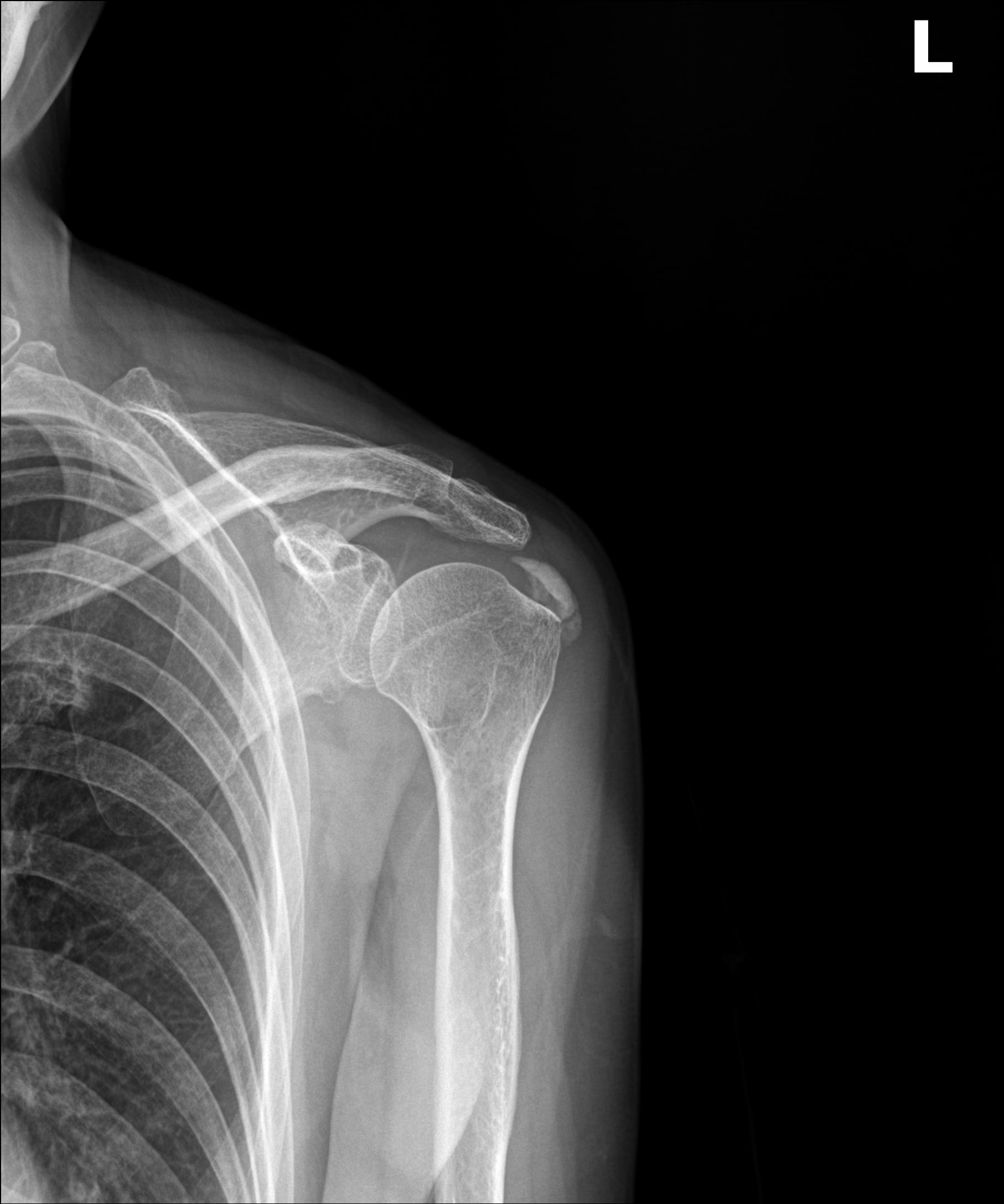 석회성건염 X-ray 영상