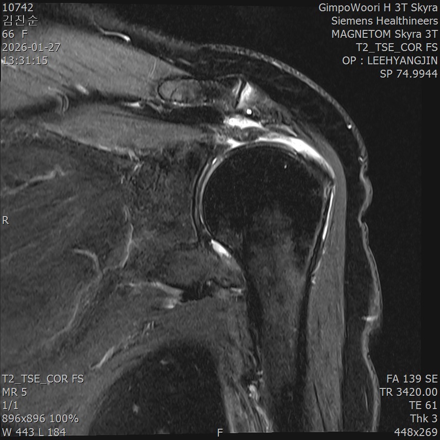 회전근개 파열 MRI 영상
