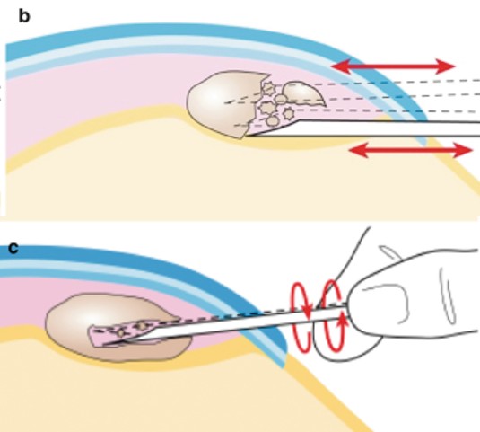 주사흡입술(Barbotage) 2-needle technique 개념도