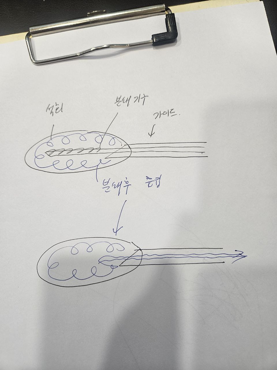 석회분쇄흡입술 개념도
