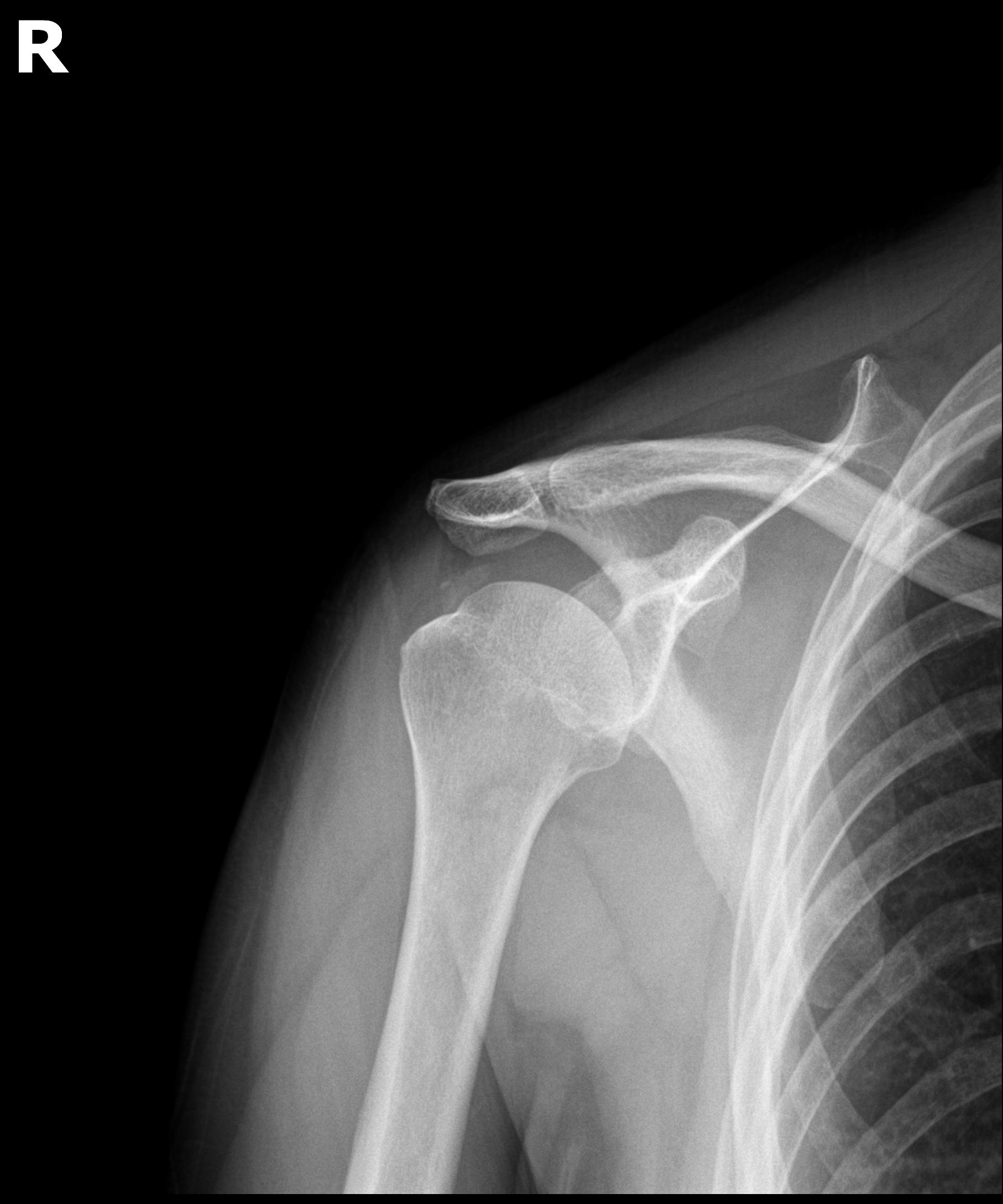 시술 후 X-ray: 석회 완전 제거