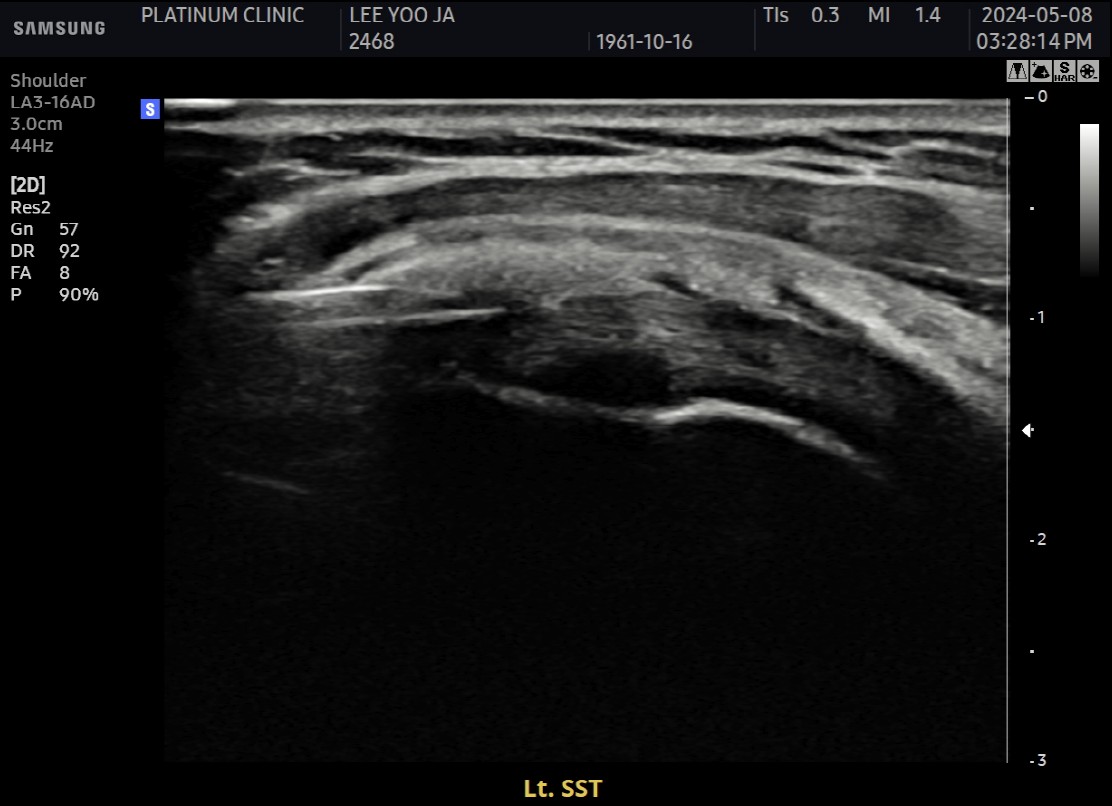 특수 가이드 삽입 모습