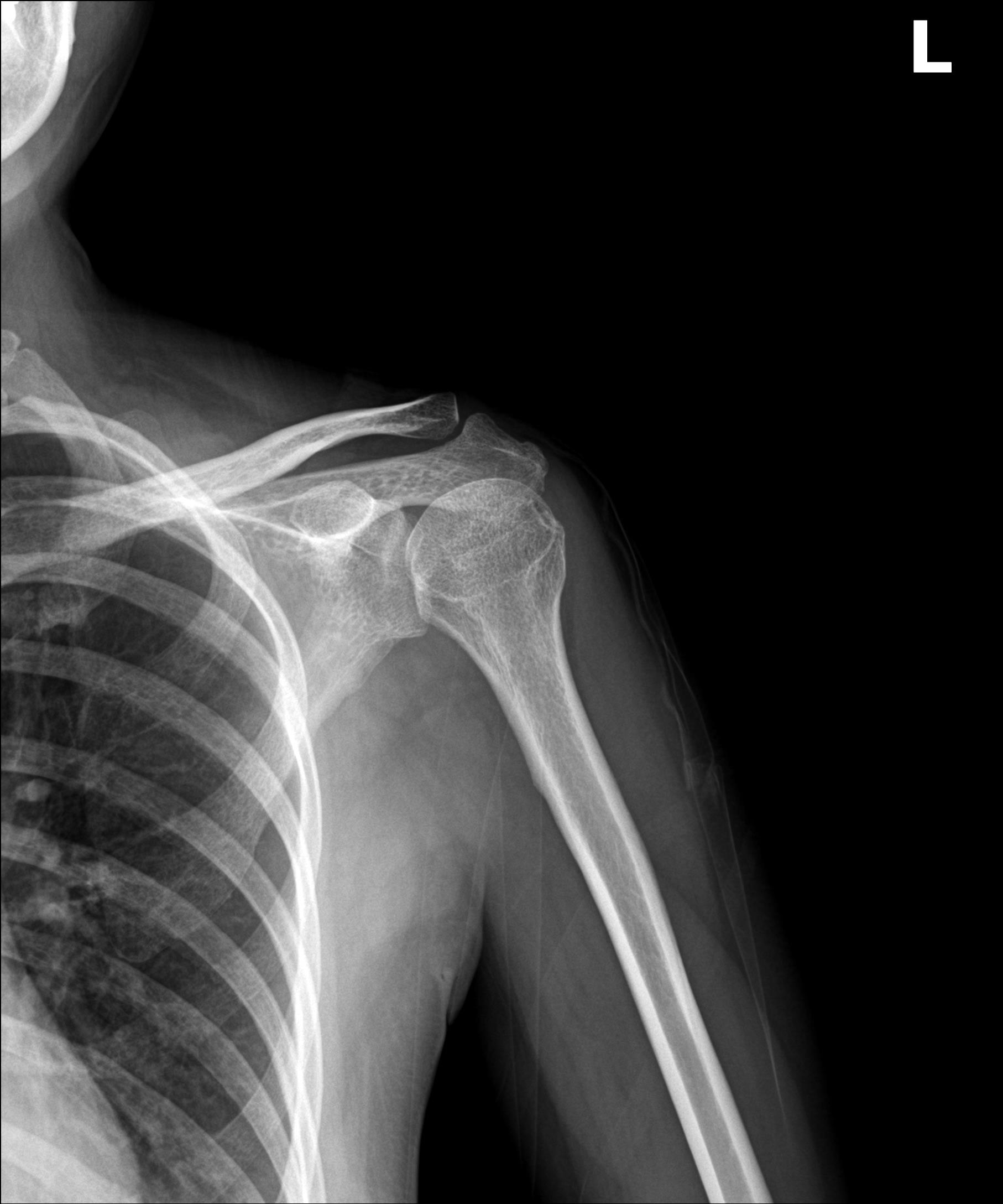 시술 후 초음파: 석회 제거됨