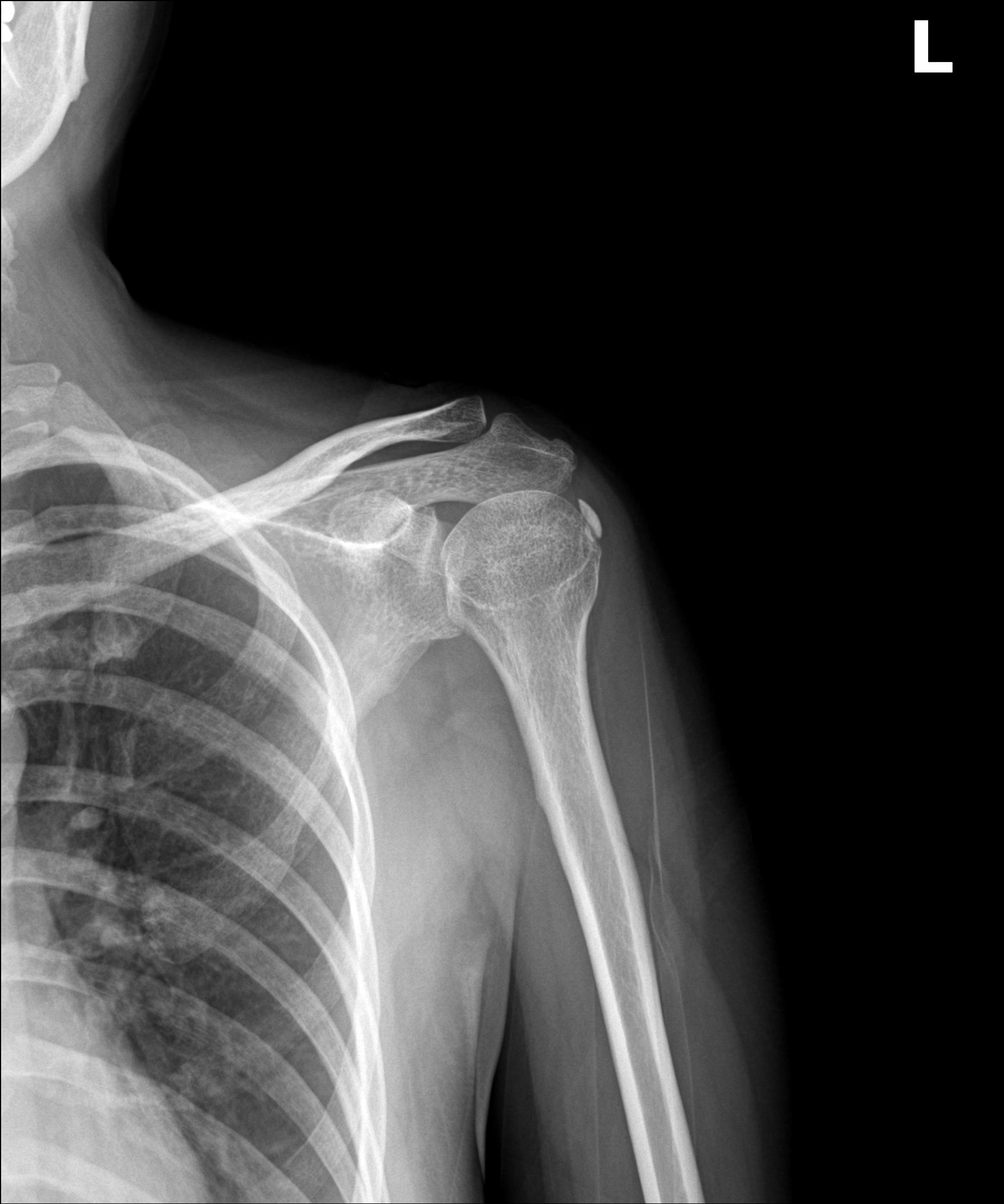 시술 전 초음파: 휴지기 석회