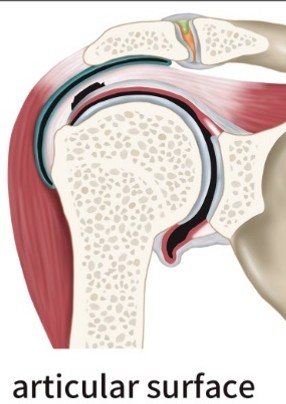 관절면측 부분파열 모식도