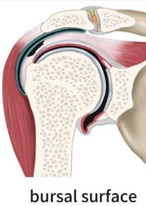 점액낭면측 부분파열 모식도