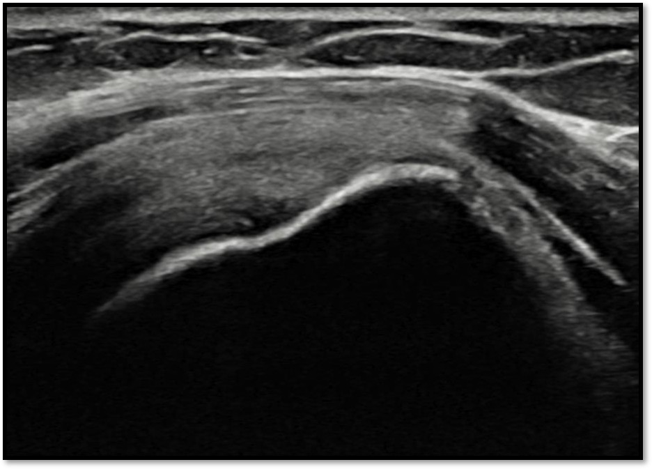케이스 1: 치료 후 초음파