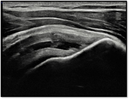 케이스 3: 골수자극 후 재생 과정 1