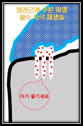 골수자극 + 재생주사 + 미세전류 복합 치료