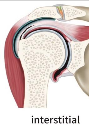 세로(결따라) 파열 모식도