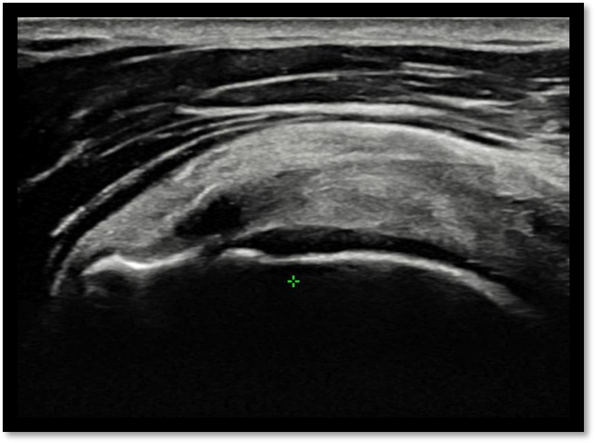관절면측 파열 위치