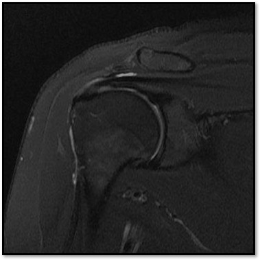 케이스 2: 시술 후 MRI