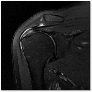 케이스 2: 시술 전 MRI