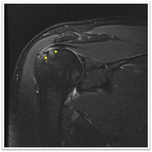 케이스 3: 시술 전 MRI