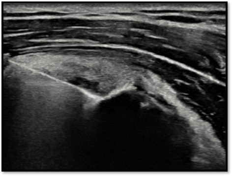 봉합사 삽입 및 인대 통과 2