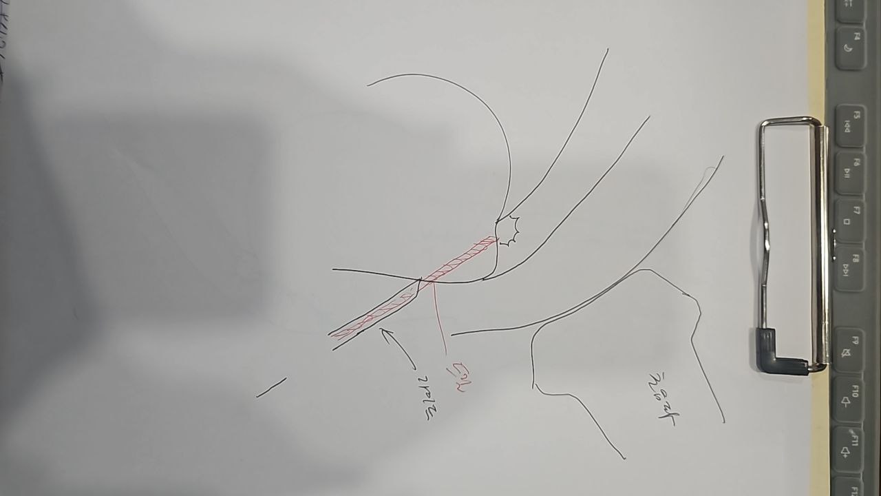 초음파 유도 하 가이드 삽입